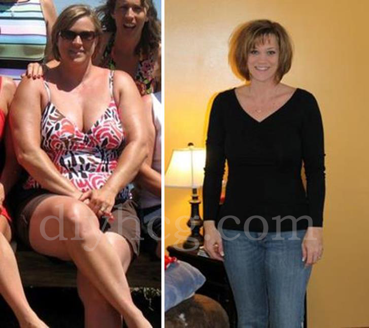 HCG Diet Before and After Photos