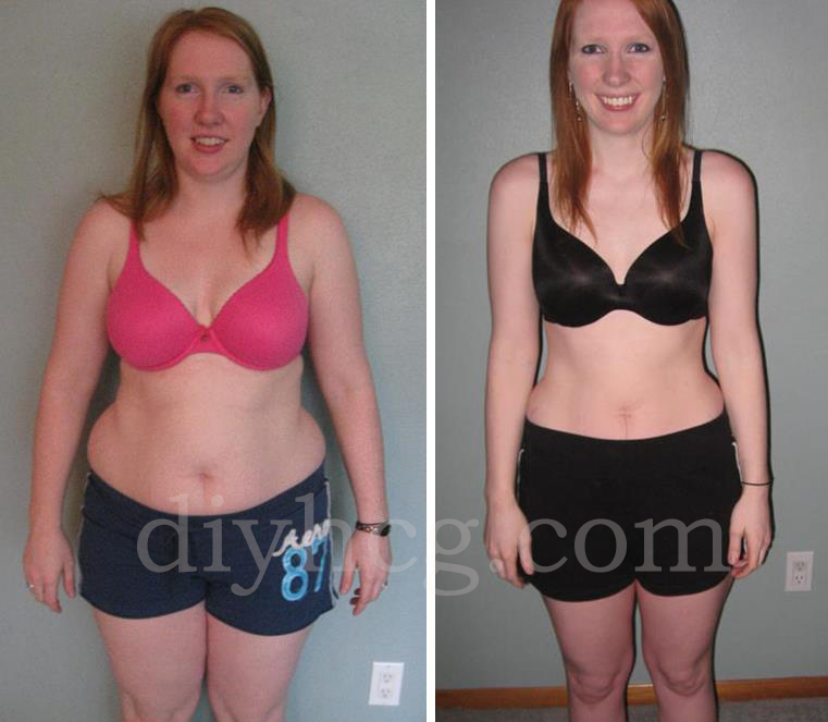 HCG Diet Before and After Photos