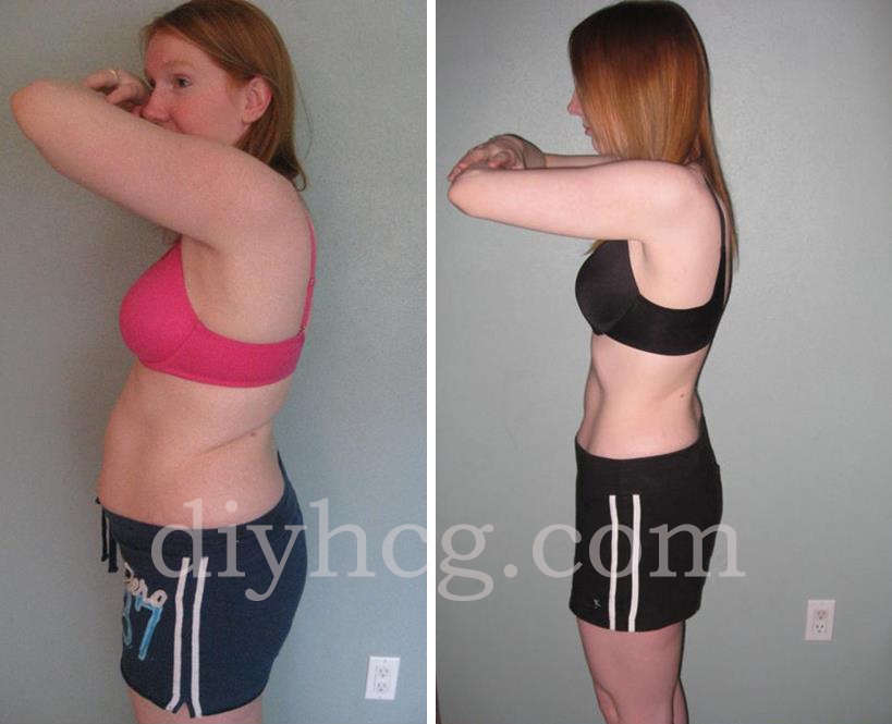 Lost 45 pounds in 7 months with this HCG plan! Wow! She looks amazing!