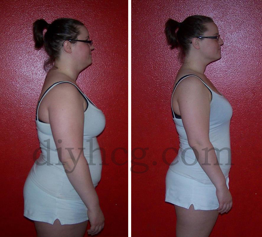 Before and After HCG Story Using Diet Drops
